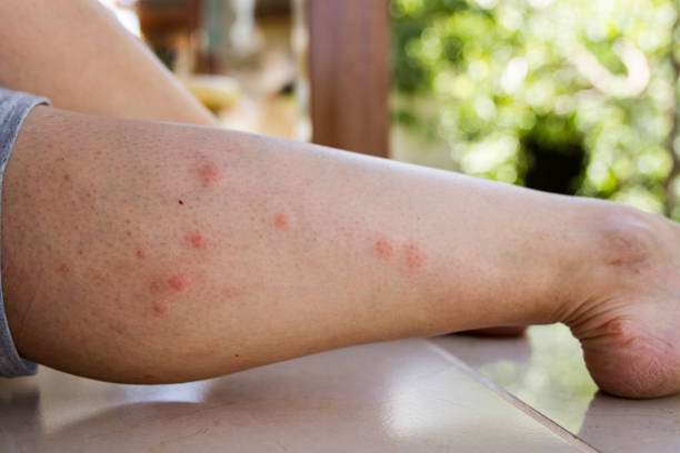 Sivrisinek Isırığından Ne Tür Hastalıklar Bulaşır?